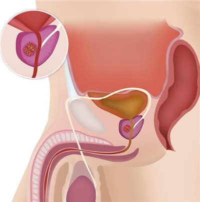 前列腺最怕6件事，90%的男性都中招，冬天护好3处保健康图1