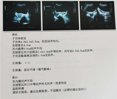 妇检发现阴道后穹窿破裂口深达肌层！患者却说没有诱因？