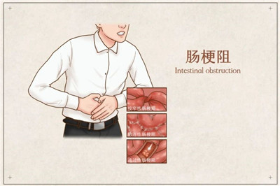 长在肚子里的结核病，腹部出现这3种症状一定要当心！图3