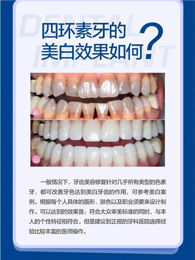 牙齿美容不仅是美白这么简单图3