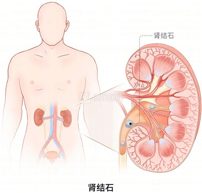 有这 4 个习惯的人，很容易被肾结石盯上图2